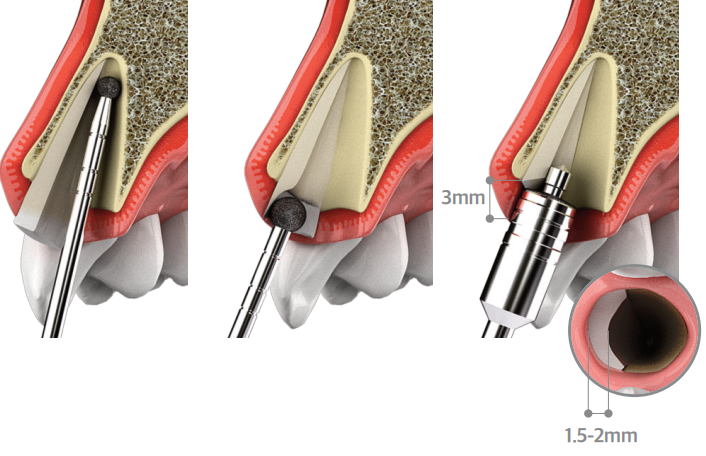 Root Membrane Kit [Partial Extraction Therapy]
