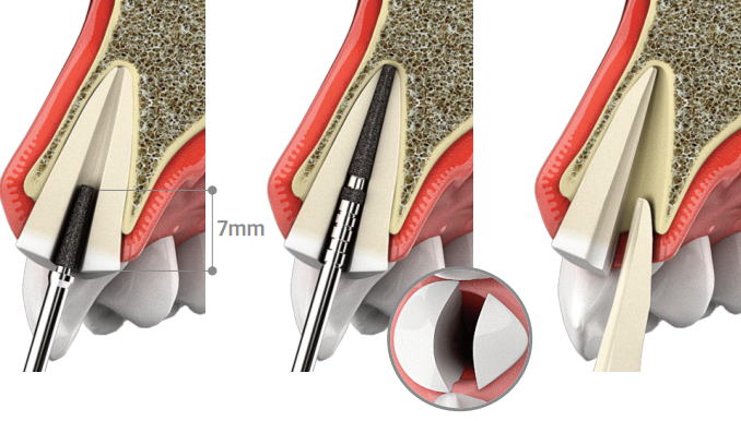 Root Membrane Kit [Partial Extraction Therapy]